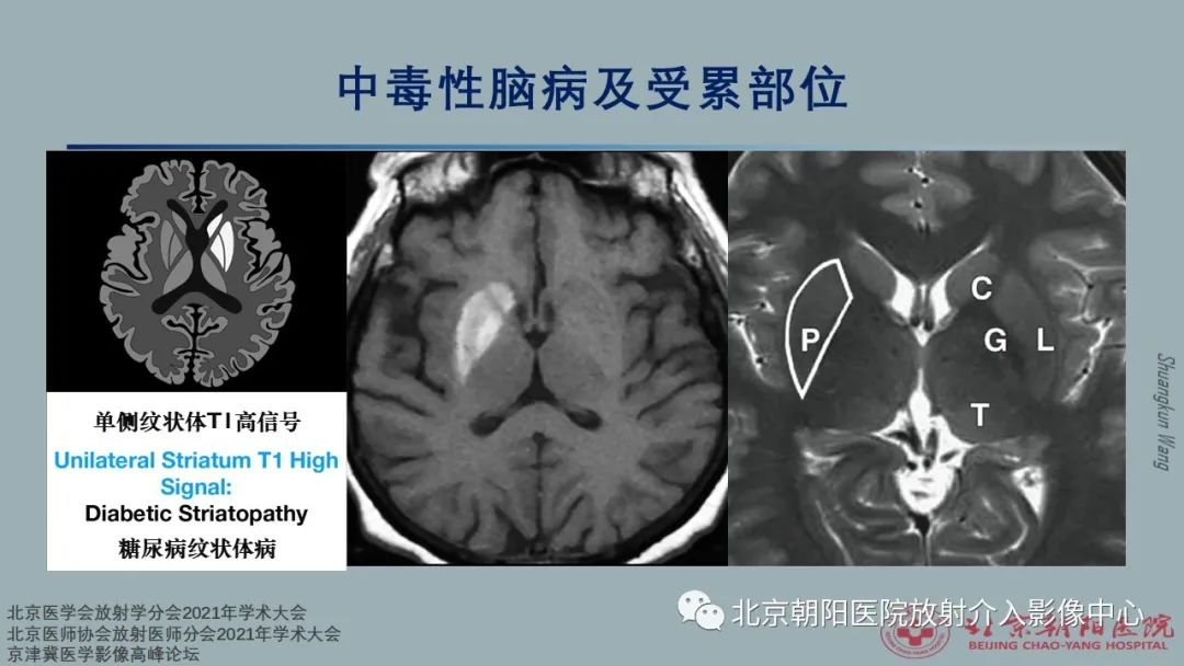影像PPT - 【PPT】中毒性脑病（TEP）影像表现模式及特征-16
