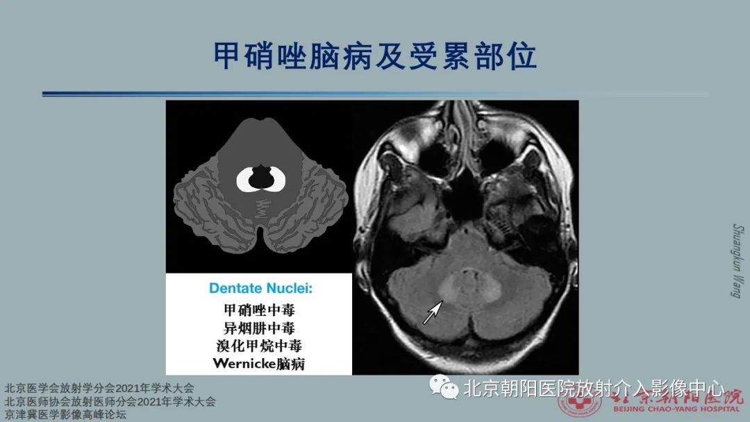 影像PPT - 【PPT】中毒性脑病（TEP）影像表现模式及特征-22