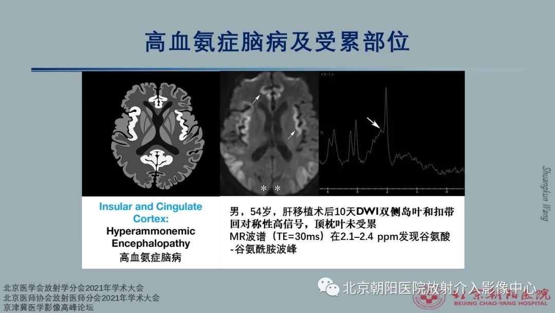 影像PPT - 【PPT】中毒性脑病（TEP）影像表现模式及特征-23