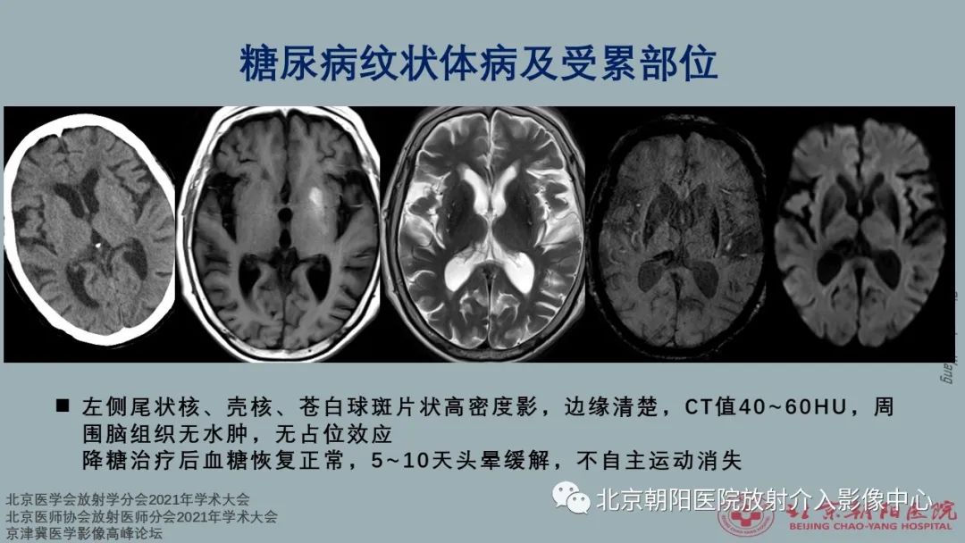 影像PPT - 【PPT】中毒性脑病（TEP）影像表现模式及特征-21