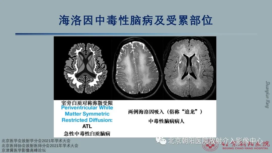 影像PPT - 【PPT】中毒性脑病（TEP）影像表现模式及特征-24