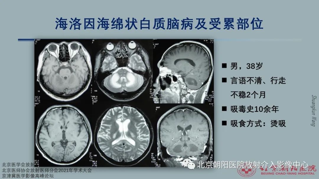 影像PPT - 【PPT】中毒性脑病（TEP）影像表现模式及特征-27