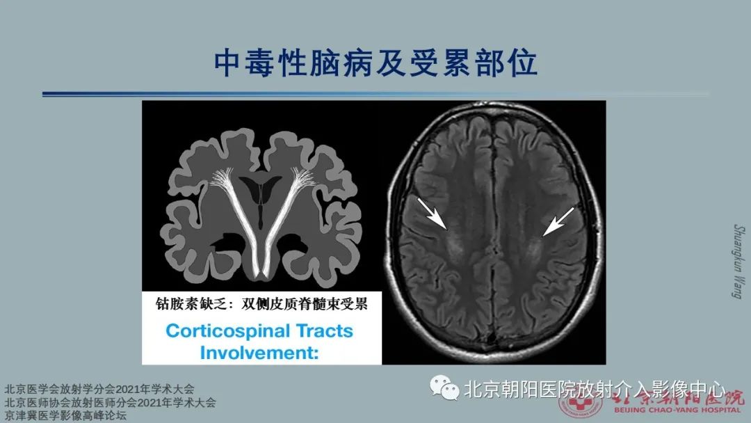 影像PPT - 【PPT】中毒性脑病（TEP）影像表现模式及特征-28