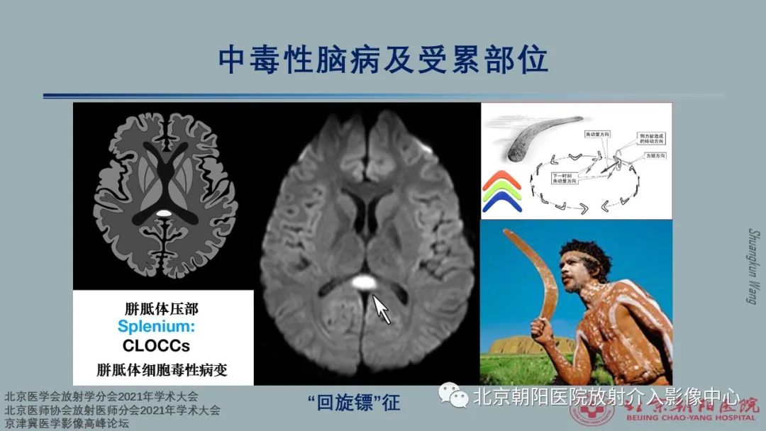 影像PPT - 【PPT】中毒性脑病（TEP）影像表现模式及特征-29
