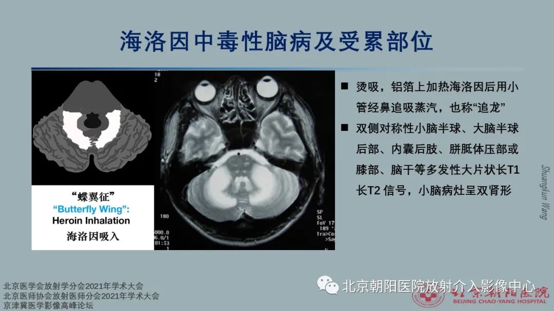 影像PPT - 【PPT】中毒性脑病（TEP）影像表现模式及特征-25