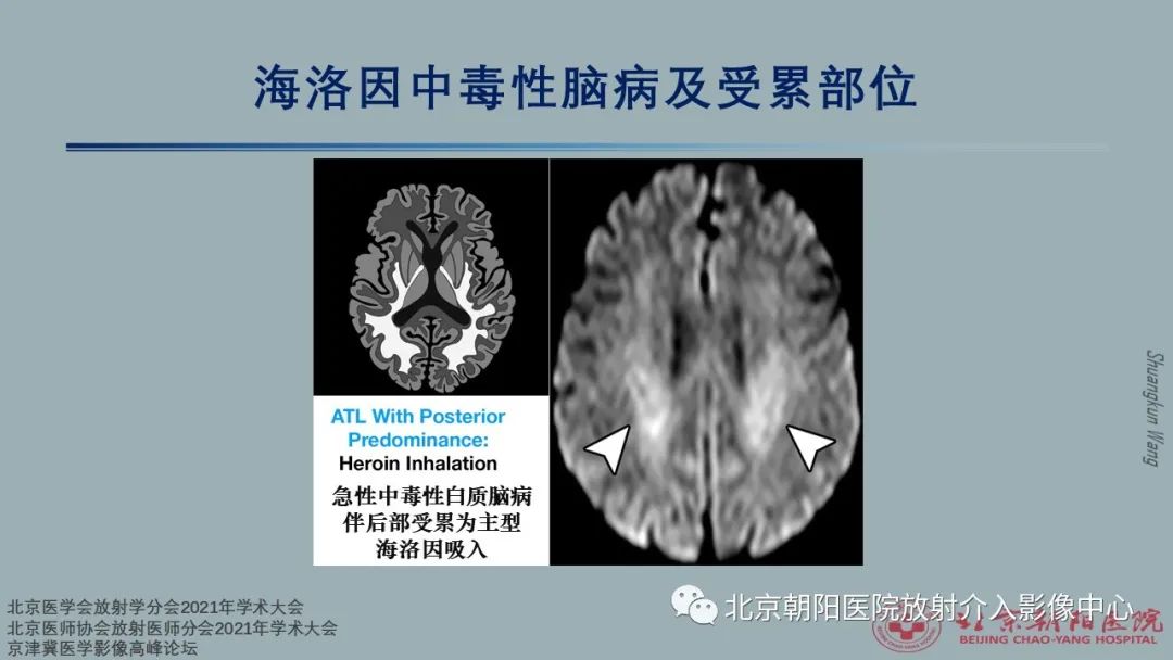 影像PPT - 【PPT】中毒性脑病（TEP）影像表现模式及特征-26