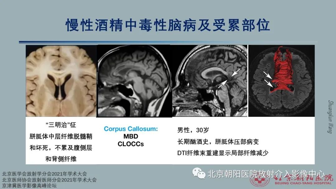 影像PPT - 【PPT】中毒性脑病（TEP）影像表现模式及特征-30
