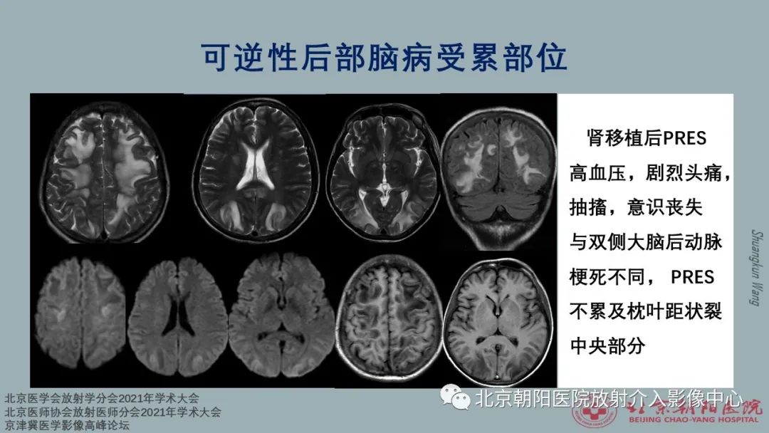 影像PPT - 【PPT】中毒性脑病（TEP）影像表现模式及特征-32