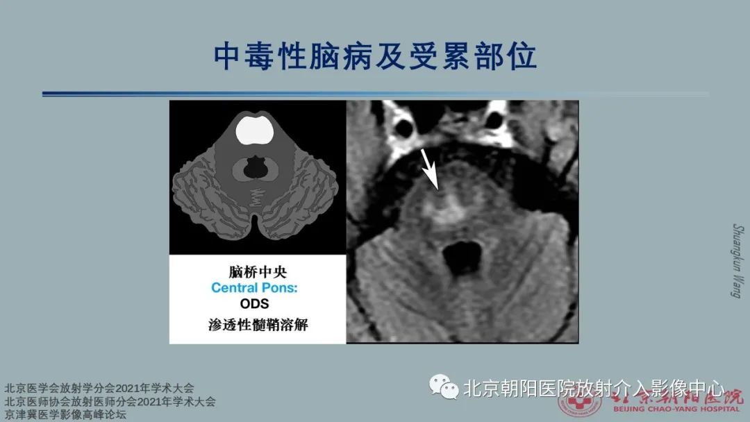 影像PPT - 【PPT】中毒性脑病（TEP）影像表现模式及特征-33