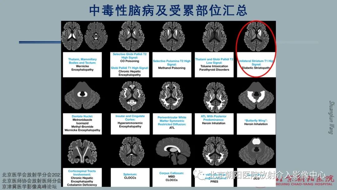 影像PPT - 【PPT】中毒性脑病（TEP）影像表现模式及特征-36