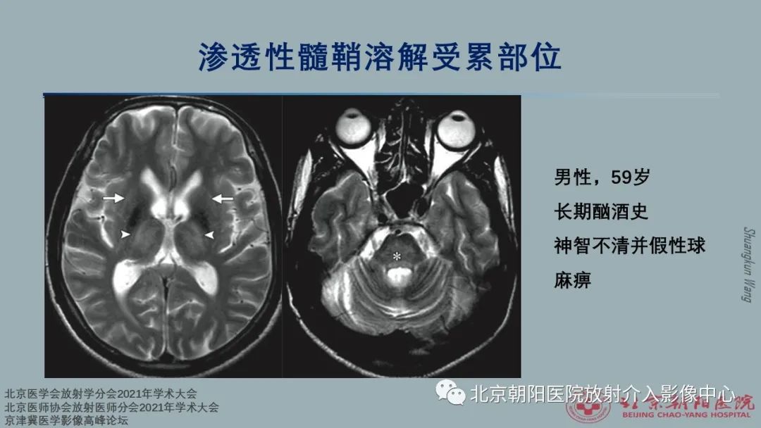 影像PPT - 【PPT】中毒性脑病（TEP）影像表现模式及特征-34