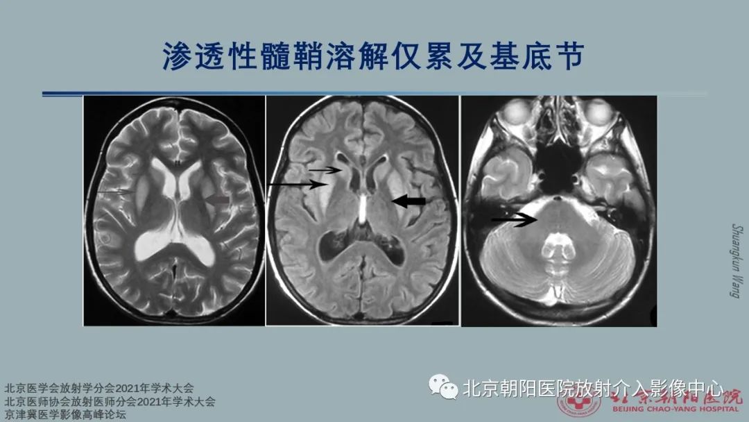 影像PPT - 【PPT】中毒性脑病（TEP）影像表现模式及特征-35