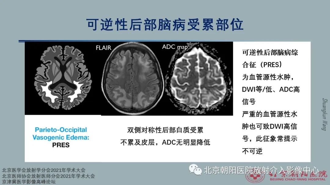 影像PPT - 【PPT】中毒性脑病（TEP）影像表现模式及特征-31