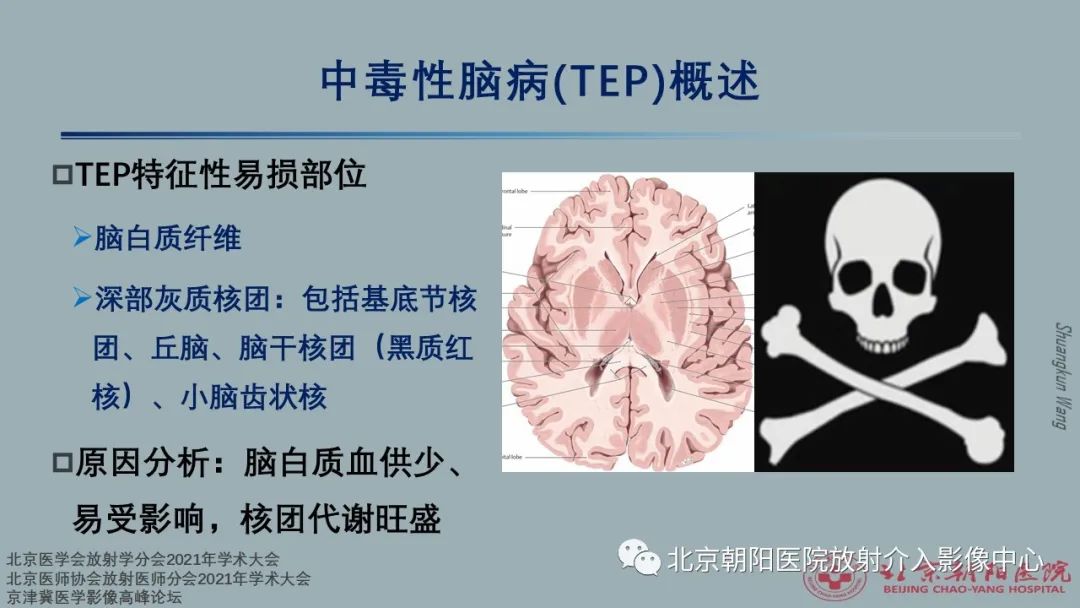 影像PPT - 【PPT】中毒性脑病（TEP）影像表现模式及特征-1