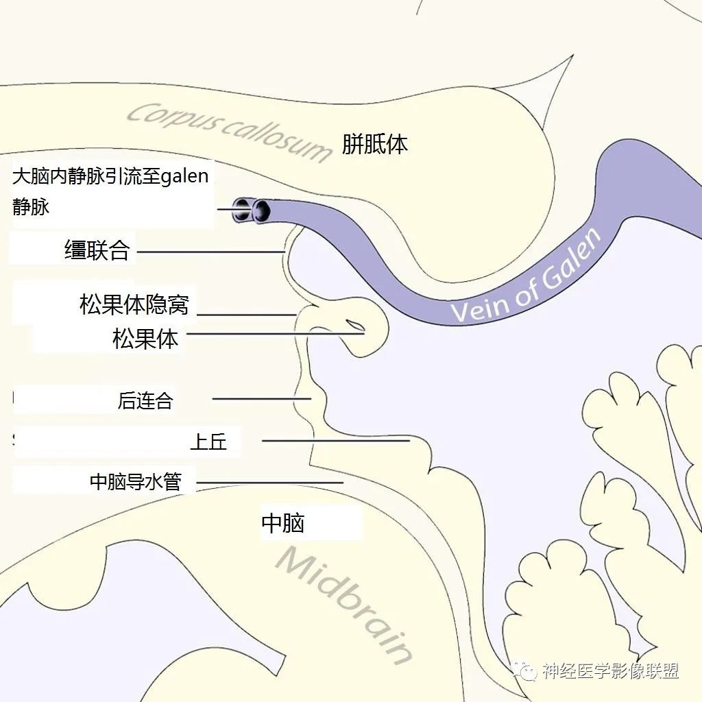 影像PPT - 松果体区病变汇总-1 影像PPT - 松果体区病变汇总-1