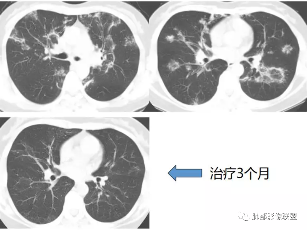 影像PPT - 【病例】支气管血管束周围实变影—机化性肺炎OP一例-12 影像PPT - 【病例】支气管血管束周围实变影—机化性肺炎OP一例-12