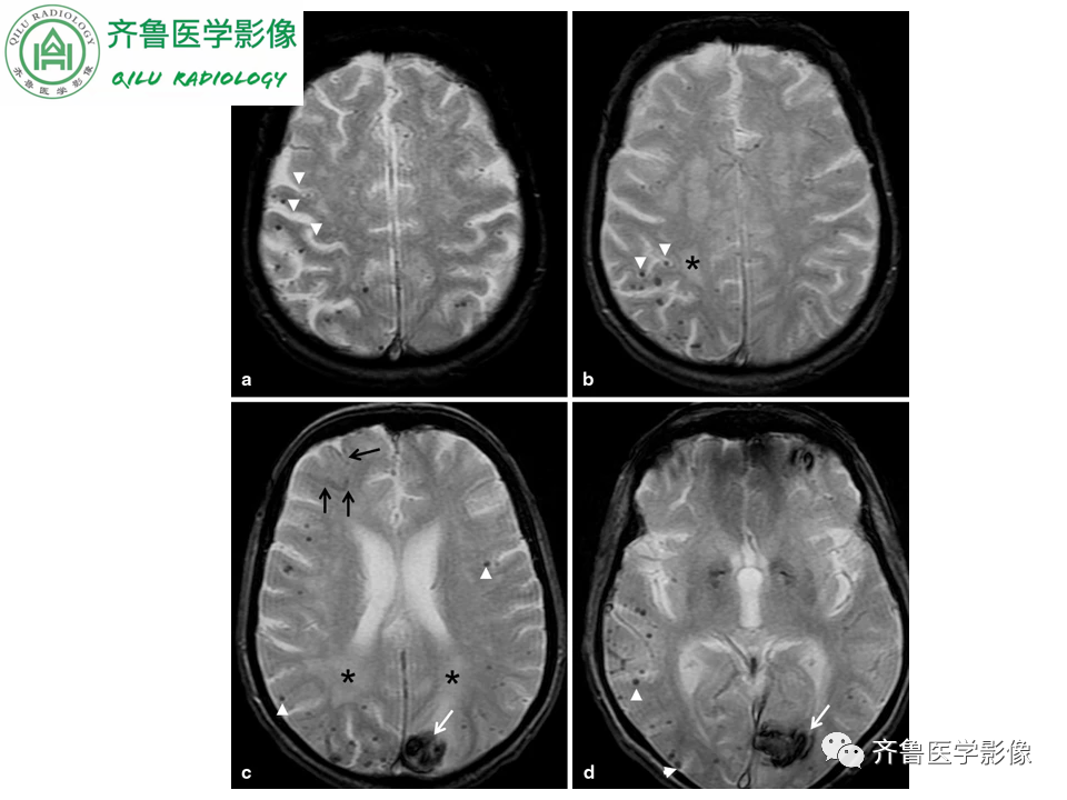 影像PPT - 【PPT】脑微出血CMB-14