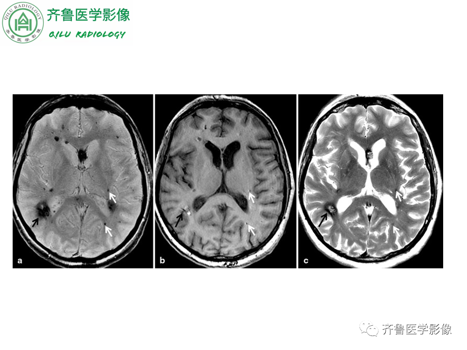 影像PPT - 【PPT】脑微出血CMB-19