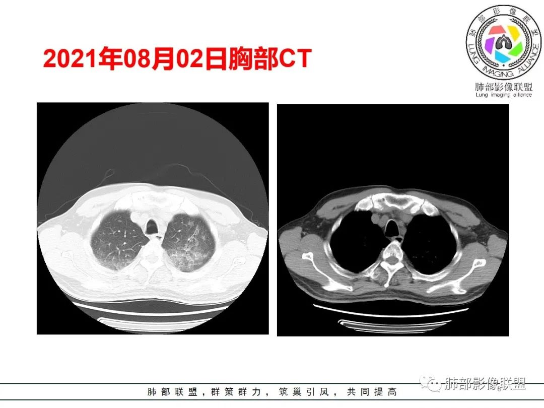 影像PPT - 【病例】神经源性肺水肿1例CT影像-8 影像PPT - 【病例】神经源性肺水肿1例CT影像-8