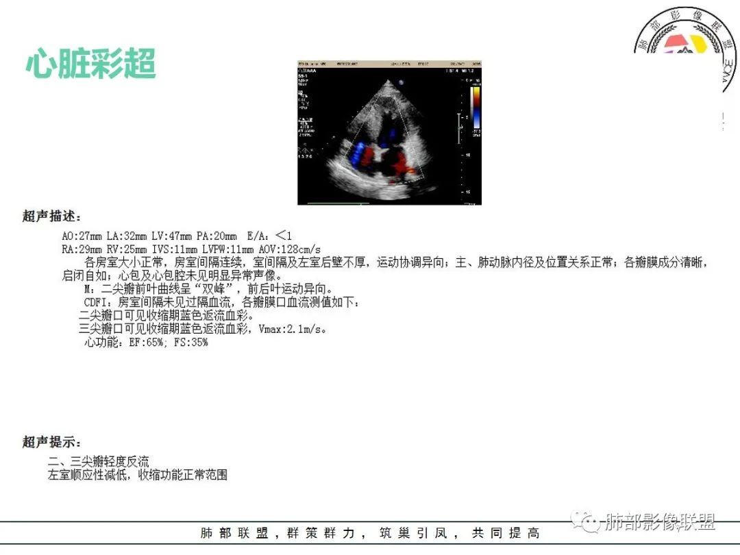 影像PPT - 【病例】神经源性肺水肿1例CT影像-7 影像PPT - 【病例】神经源性肺水肿1例CT影像-7