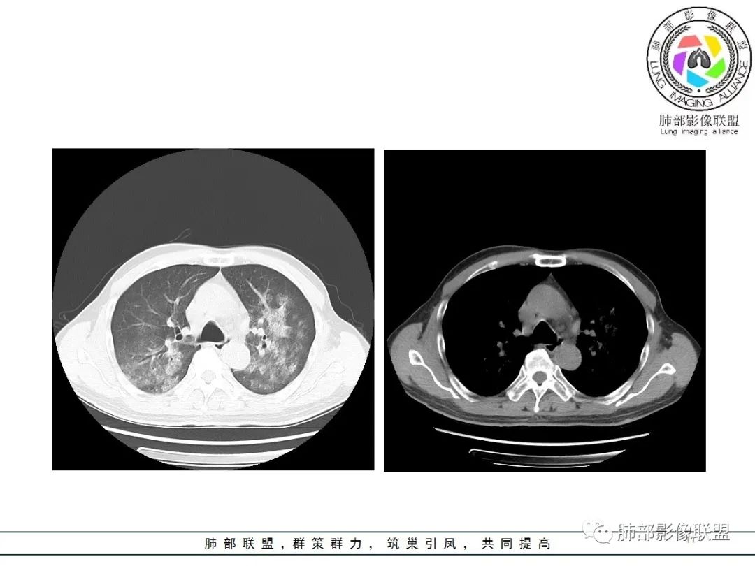 影像PPT - 【病例】神经源性肺水肿1例CT影像-11 影像PPT - 【病例】神经源性肺水肿1例CT影像-11