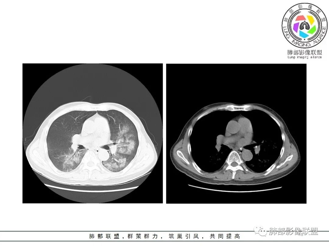 影像PPT - 【病例】神经源性肺水肿1例CT影像-13 影像PPT - 【病例】神经源性肺水肿1例CT影像-13