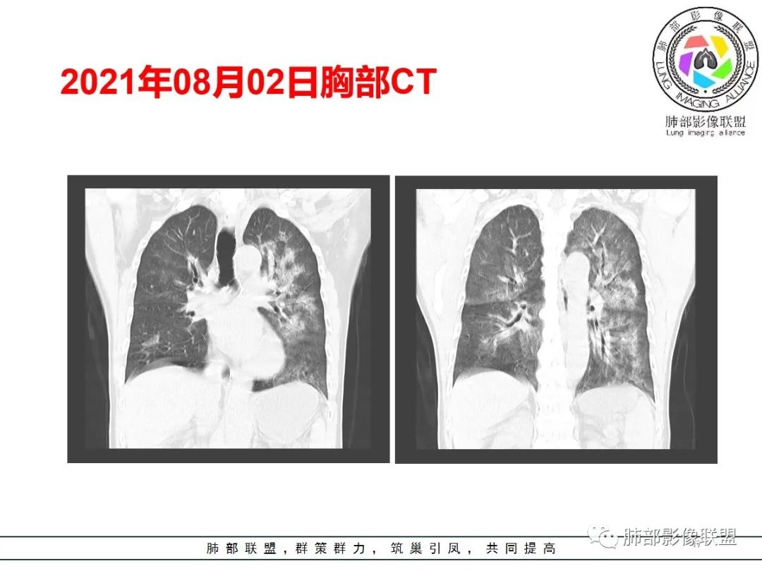 影像PPT - 【病例】神经源性肺水肿1例CT影像-17 影像PPT - 【病例】神经源性肺水肿1例CT影像-17