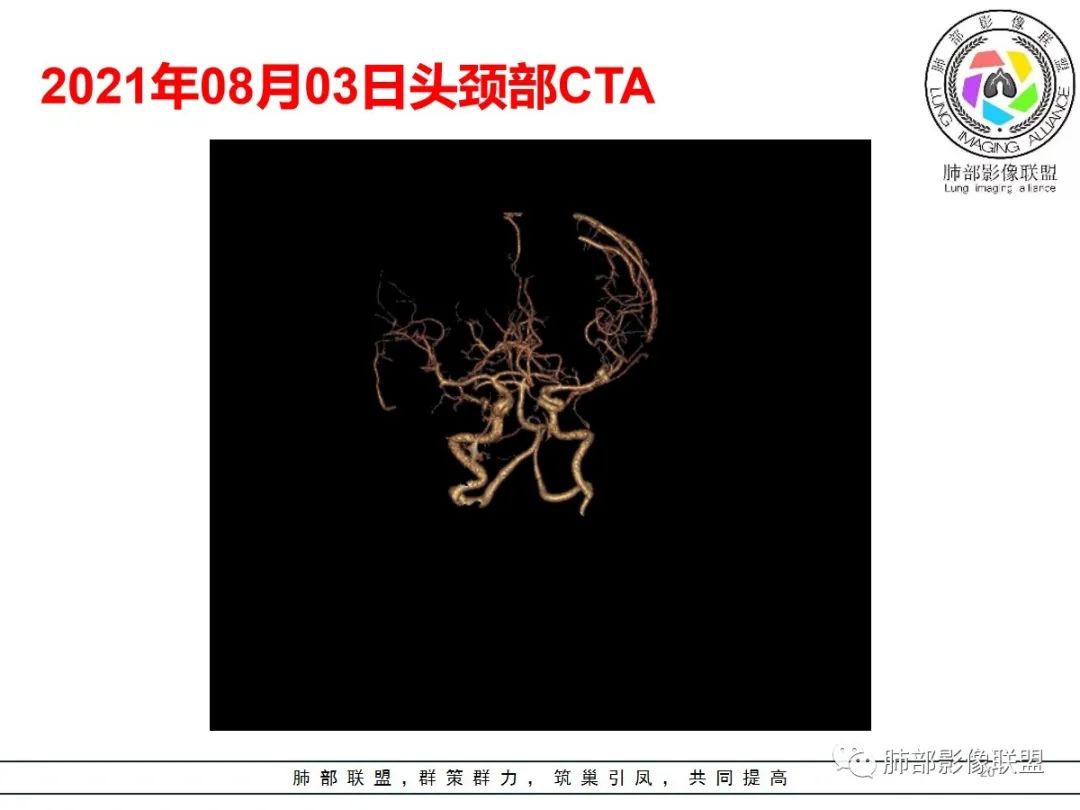 影像PPT - 【病例】神经源性肺水肿1例CT影像-20 影像PPT - 【病例】神经源性肺水肿1例CT影像-20