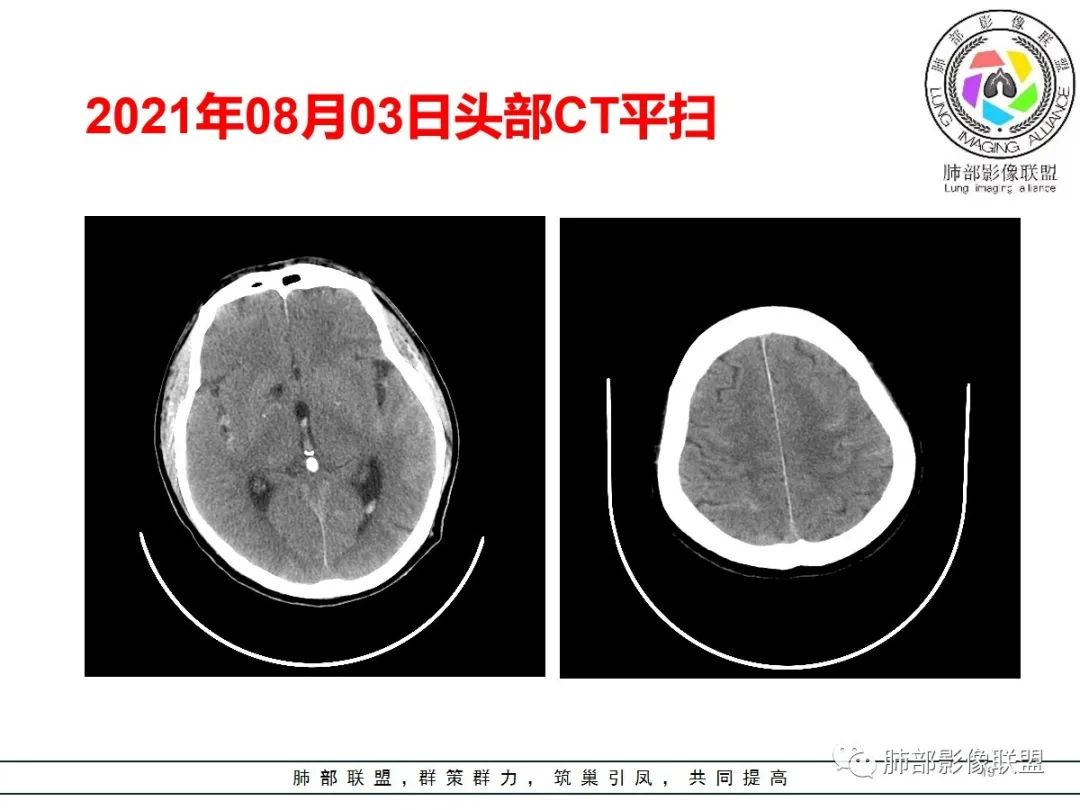 影像PPT - 【病例】神经源性肺水肿1例CT影像-19 影像PPT - 【病例】神经源性肺水肿1例CT影像-19