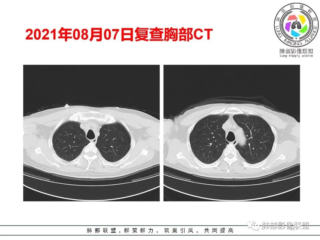 影像PPT - 【病例】神经源性肺水肿1例CT影像-22 影像PPT - 【病例】神经源性肺水肿1例CT影像-22