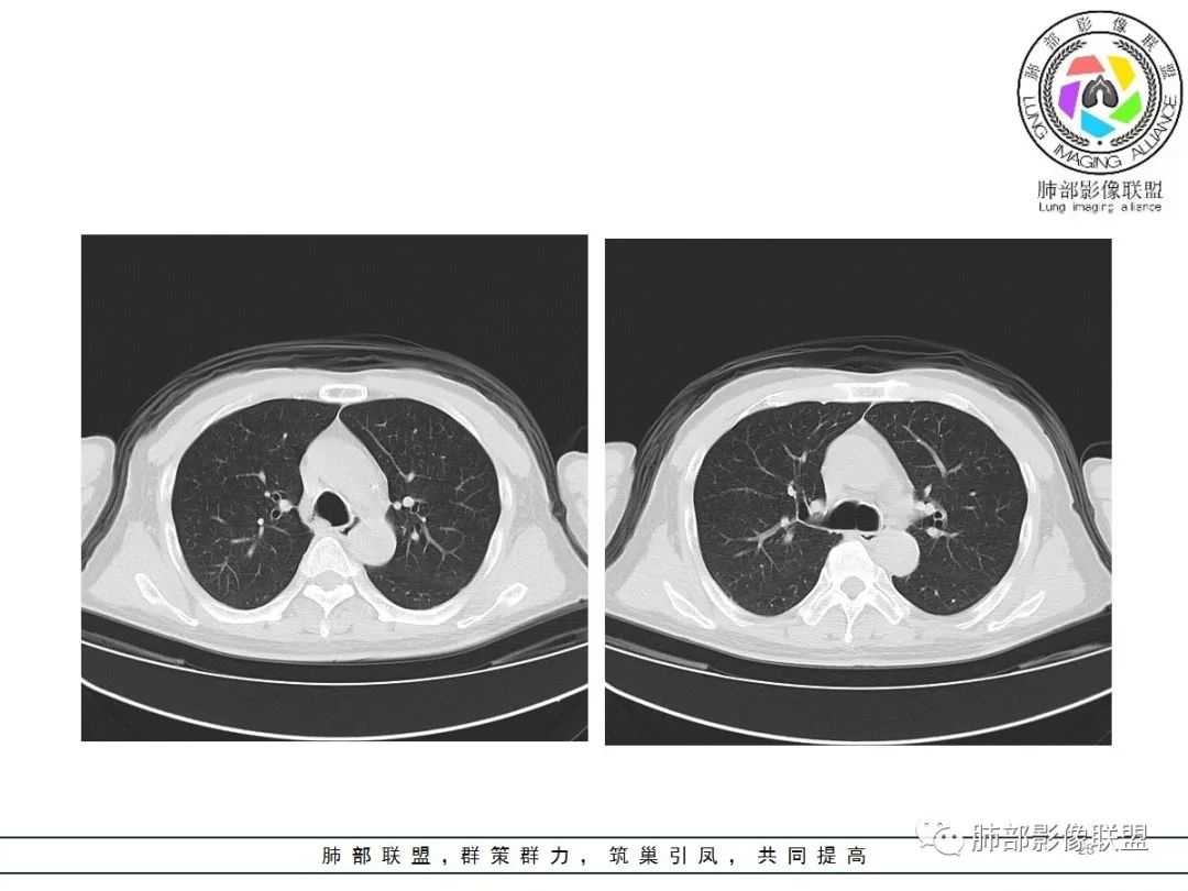 影像PPT - 【病例】神经源性肺水肿1例CT影像-23 影像PPT - 【病例】神经源性肺水肿1例CT影像-23