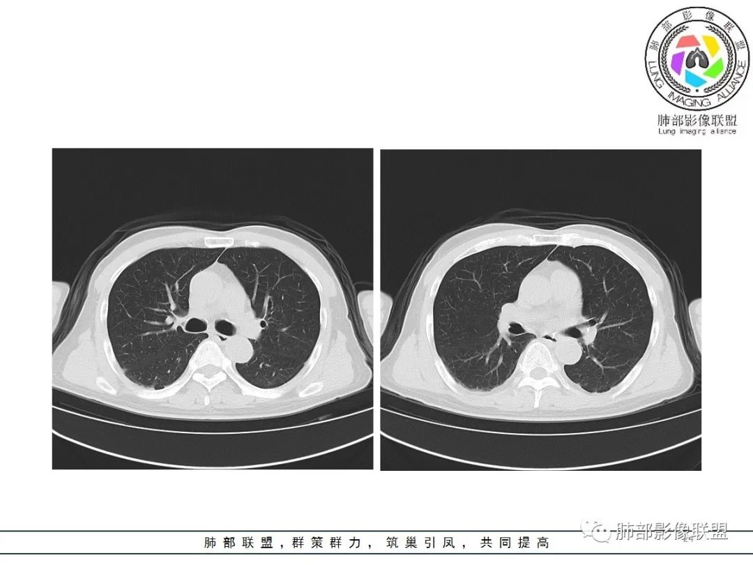 影像PPT - 【病例】神经源性肺水肿1例CT影像-24 影像PPT - 【病例】神经源性肺水肿1例CT影像-24