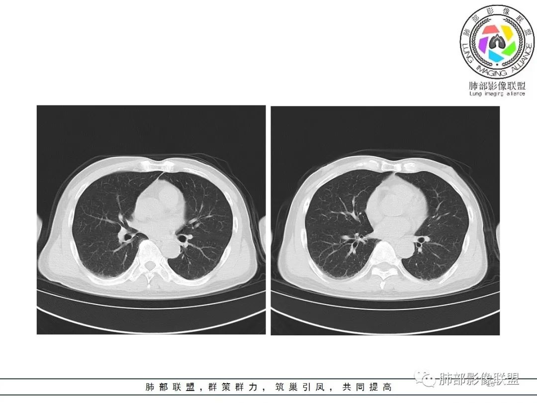 影像PPT - 【病例】神经源性肺水肿1例CT影像-25 影像PPT - 【病例】神经源性肺水肿1例CT影像-25