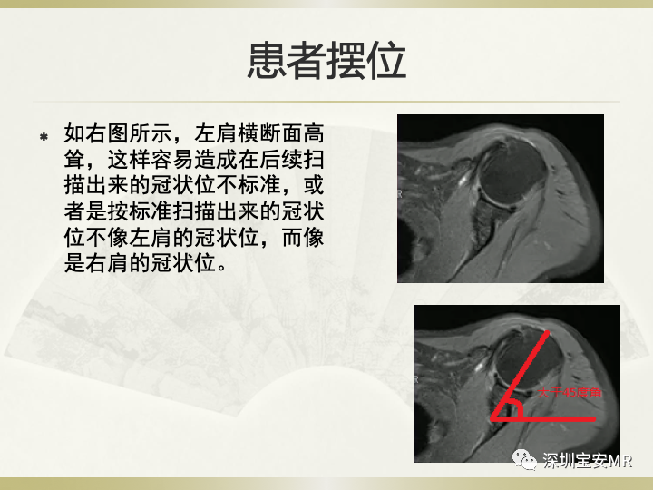 影像PPT - 【PPT】肩关节MRI检查技术-9