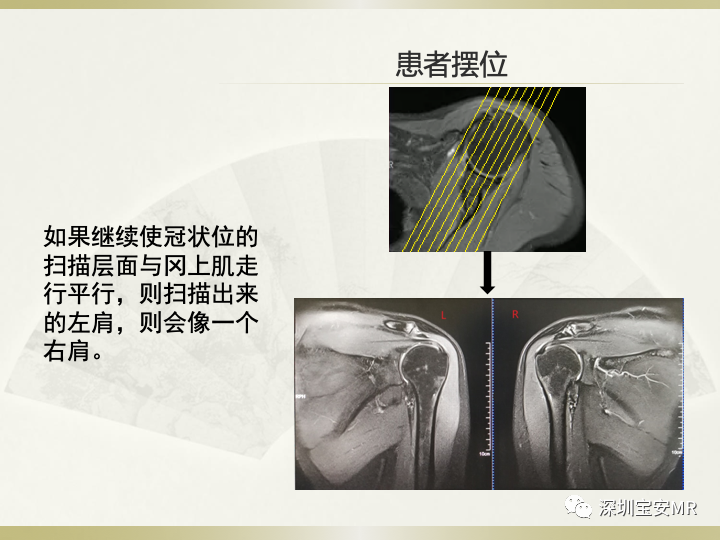 影像PPT - 【PPT】肩关节MRI检查技术-10