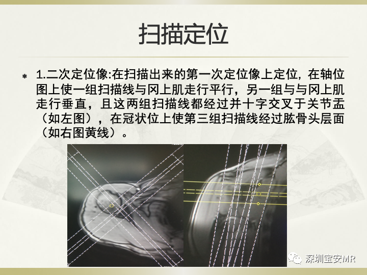 影像PPT - 【PPT】肩关节MRI检查技术-14