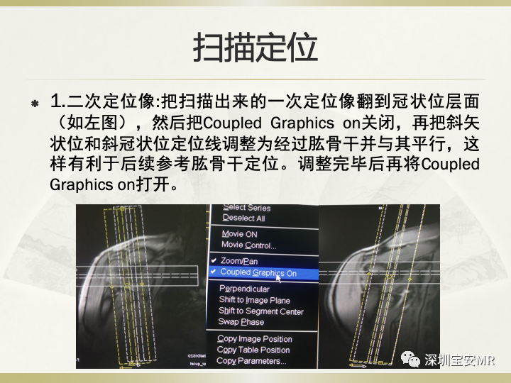 影像PPT - 【PPT】肩关节MRI检查技术-15