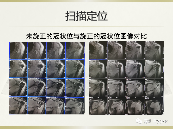 影像PPT - 【PPT】肩关节MRI检查技术-17
