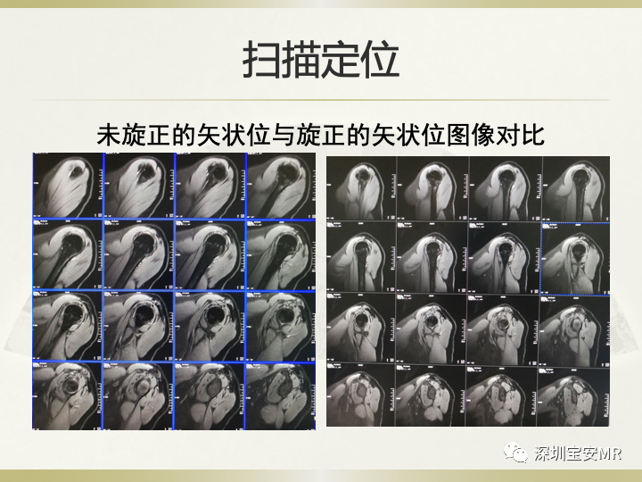 影像PPT - 【PPT】肩关节MRI检查技术-18