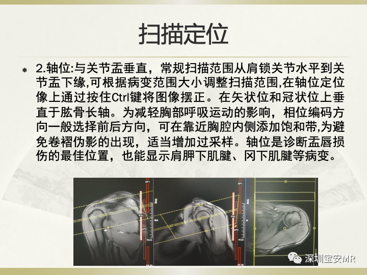 影像PPT - 【PPT】肩关节MRI检查技术-19