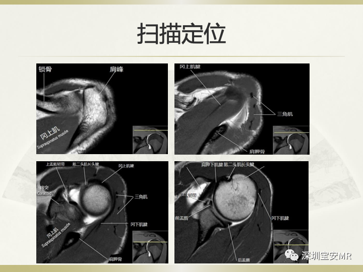 影像PPT - 【PPT】肩关节MRI检查技术-20