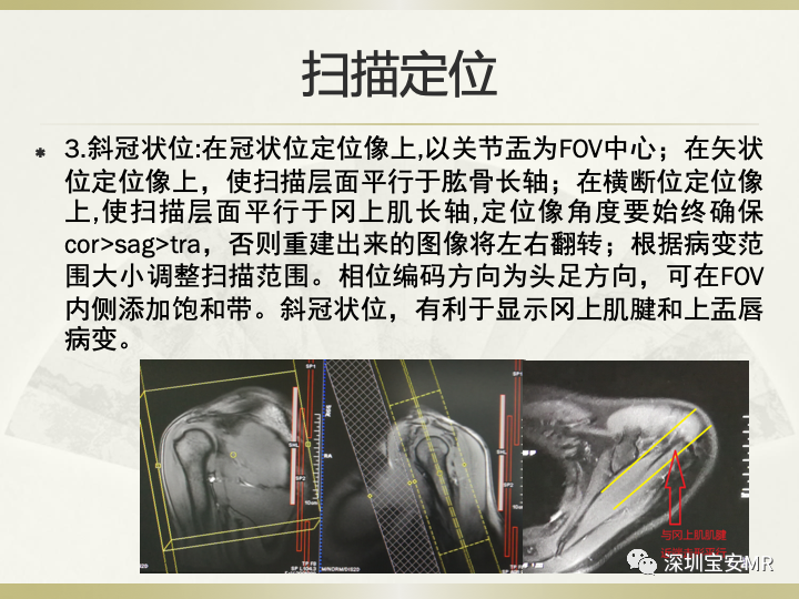 影像PPT - 【PPT】肩关节MRI检查技术-21