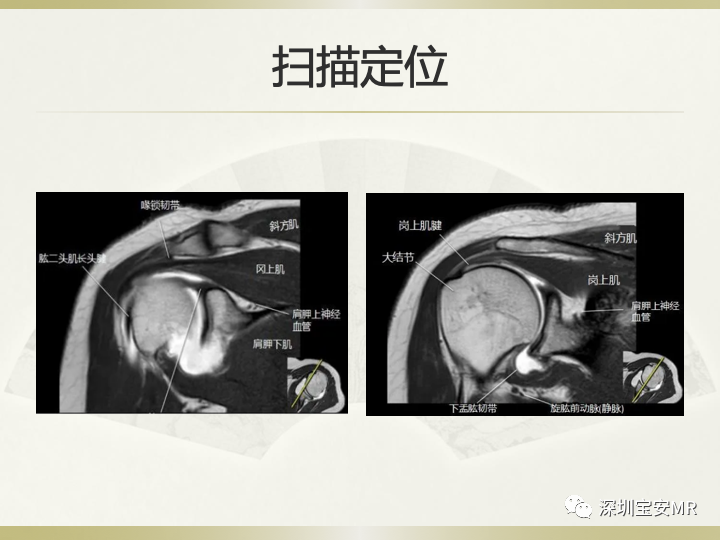 影像PPT - 【PPT】肩关节MRI检查技术-23