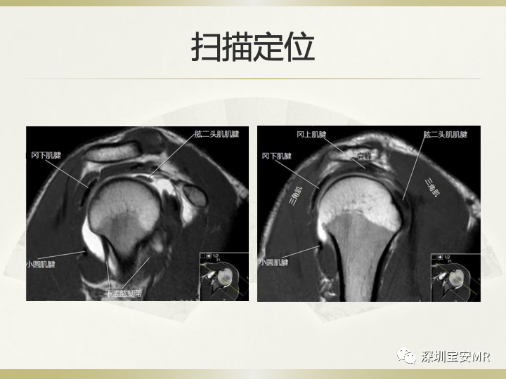 影像PPT - 【PPT】肩关节MRI检查技术-26
