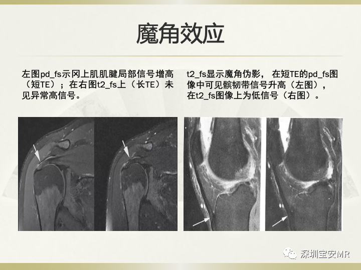 影像PPT - 【PPT】肩关节MRI检查技术-32