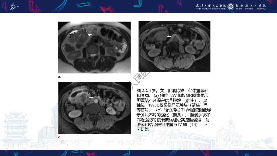 影像PPT - 【PPT】胆囊癌MRI诊断-12
