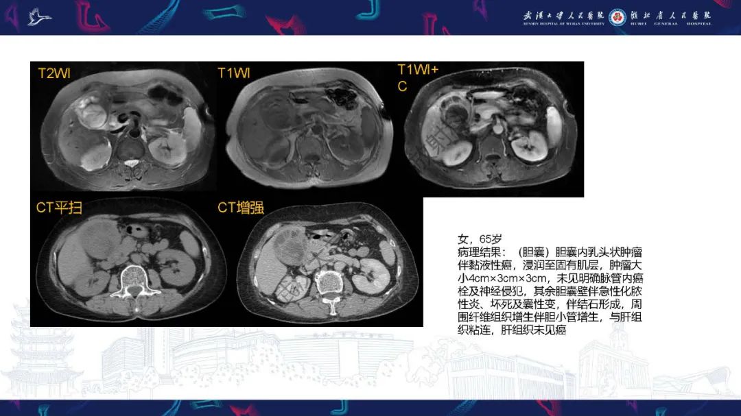 影像PPT - 【PPT】胆囊癌MRI诊断-15