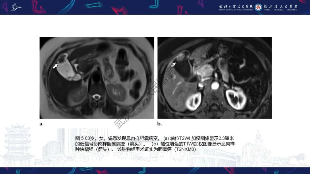 影像PPT - 【PPT】胆囊癌MRI诊断-16