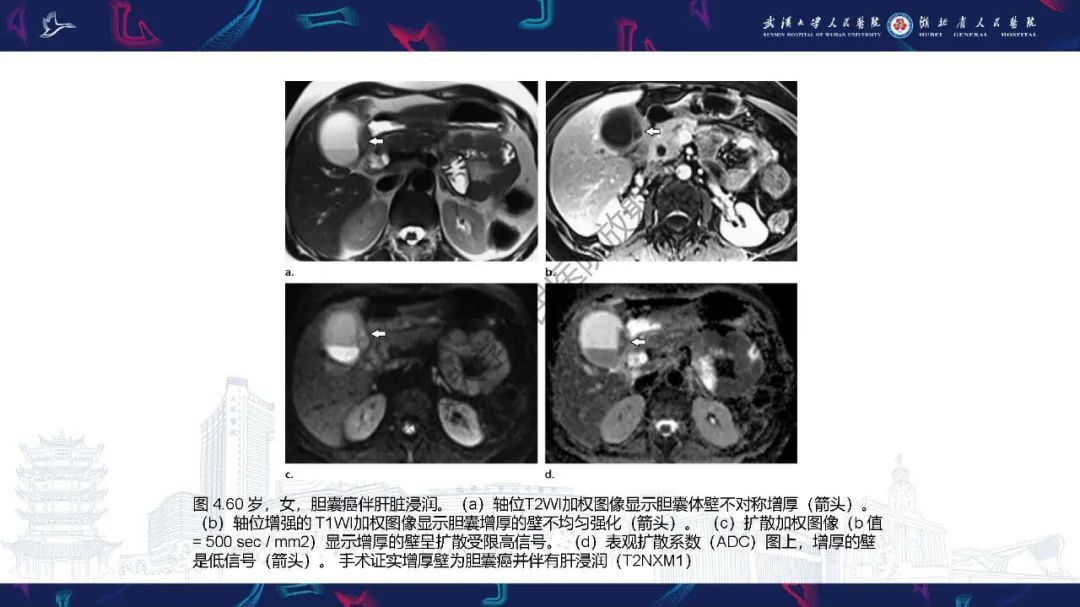 影像PPT - 【PPT】胆囊癌MRI诊断-14