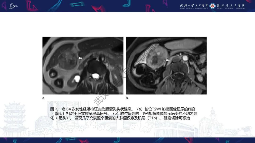 影像PPT - 【PPT】胆囊癌MRI诊断-13